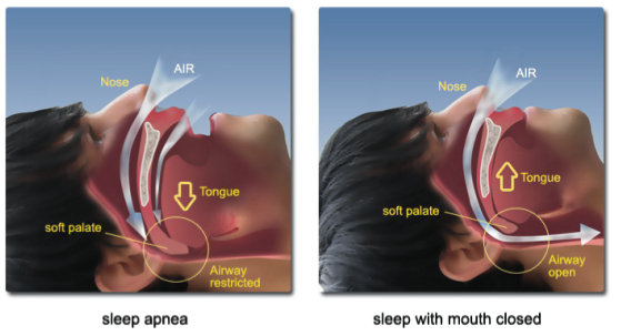 Snoring Disturbed Sleep in Children Advanced ENT