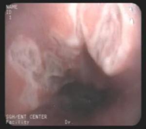 ulcer in esophagus