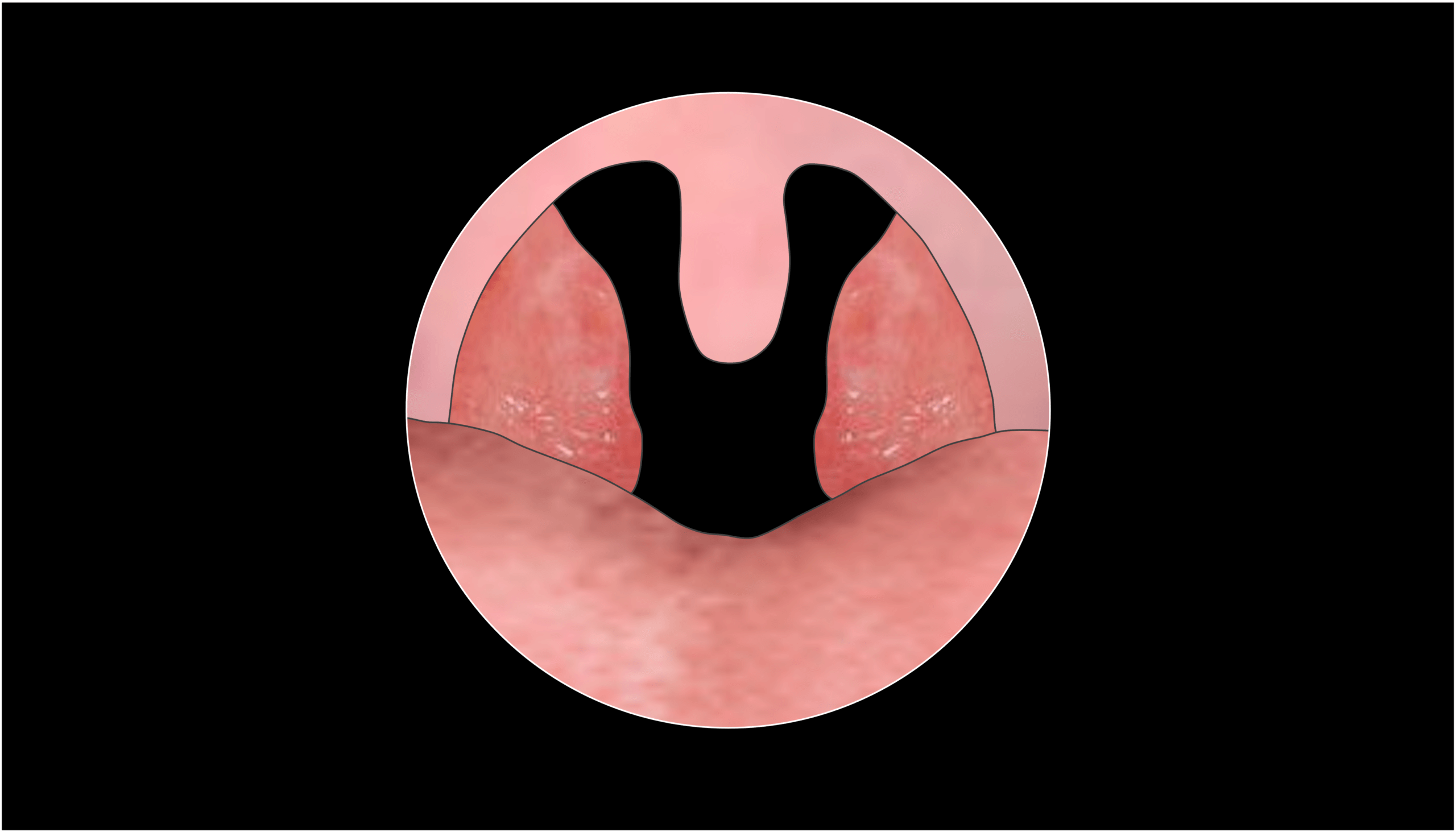 Tonsil and adenoid surgery in children – ultimate parents guide