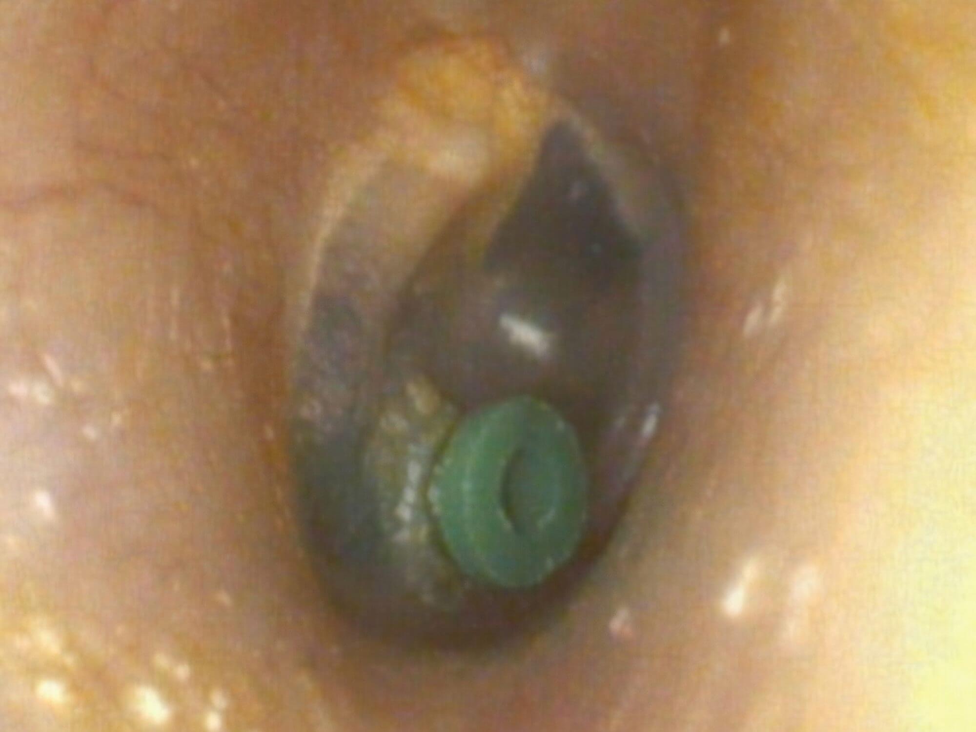 A tympanostomy tube (grommet) in the ear drum