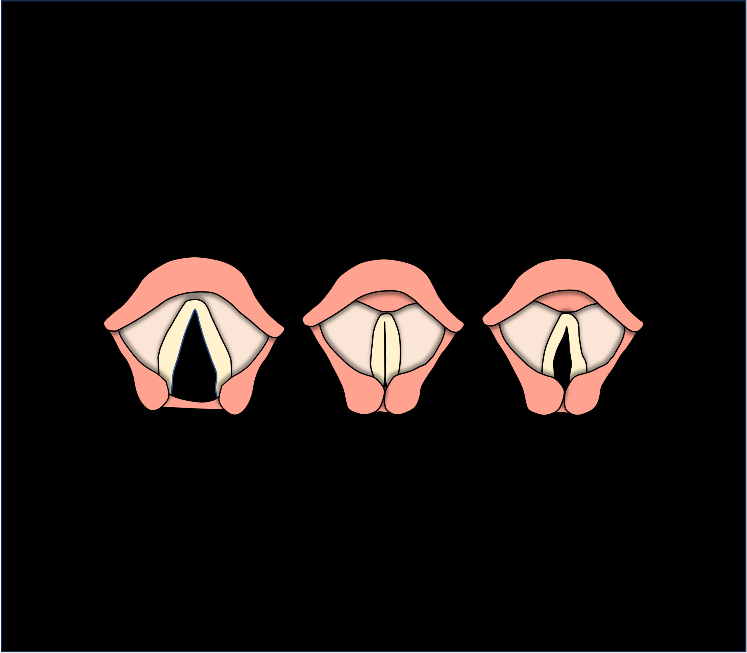 Drawing to show that the vocal folds cannot close due to left vocal fold paralysis